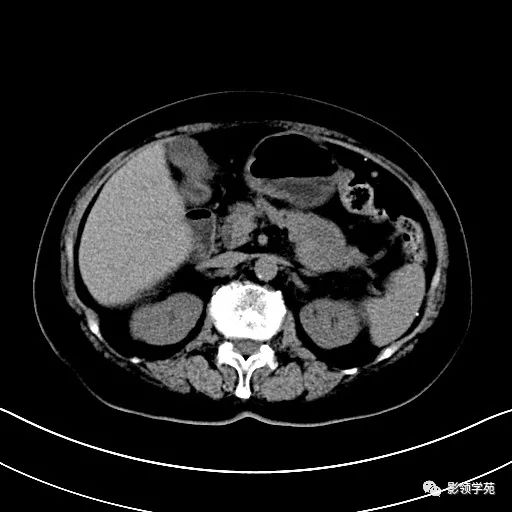 影像PPT - 【病例】胰腺实性假乳头状瘤1例CT影像-3 影像PPT - 【病例】胰腺实性假乳头状瘤1例CT影像-3