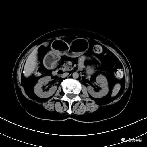 影像PPT - 【病例】胰腺实性假乳头状瘤1例CT影像-7 影像PPT - 【病例】胰腺实性假乳头状瘤1例CT影像-7