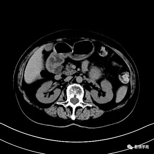影像PPT - 【病例】胰腺实性假乳头状瘤1例CT影像-6 影像PPT - 【病例】胰腺实性假乳头状瘤1例CT影像-6