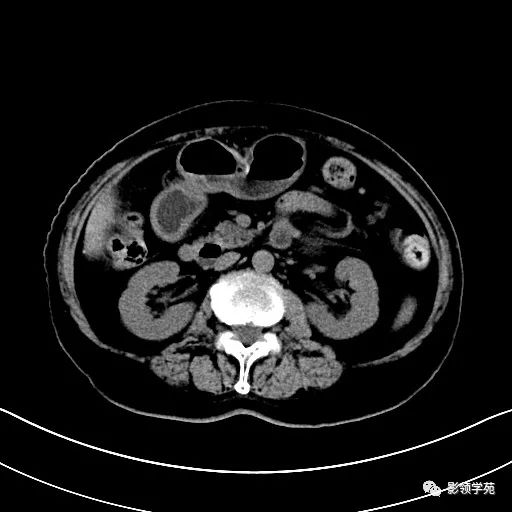 影像PPT - 【病例】胰腺实性假乳头状瘤1例CT影像-8 影像PPT - 【病例】胰腺实性假乳头状瘤1例CT影像-8