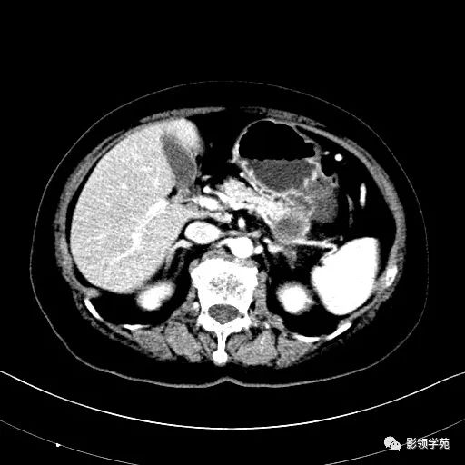 影像PPT - 【病例】胰腺实性假乳头状瘤1例CT影像-10 影像PPT - 【病例】胰腺实性假乳头状瘤1例CT影像-10