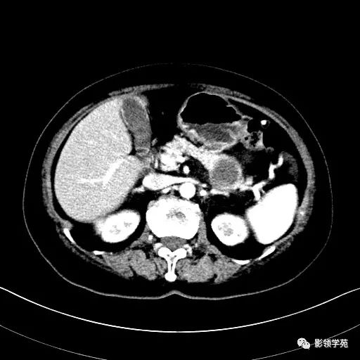 影像PPT - 【病例】胰腺实性假乳头状瘤1例CT影像-11 影像PPT - 【病例】胰腺实性假乳头状瘤1例CT影像-11