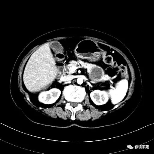影像PPT - 【病例】胰腺实性假乳头状瘤1例CT影像-12 影像PPT - 【病例】胰腺实性假乳头状瘤1例CT影像-12