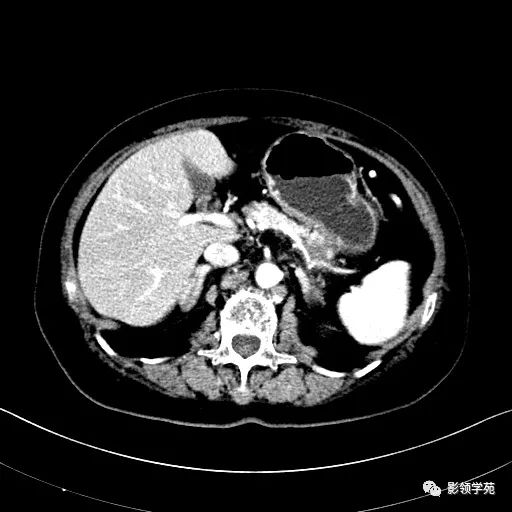影像PPT - 【病例】胰腺实性假乳头状瘤1例CT影像-9 影像PPT - 【病例】胰腺实性假乳头状瘤1例CT影像-9