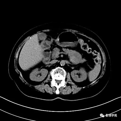 影像PPT - 【病例】胰腺实性假乳头状瘤1例CT影像-4 影像PPT - 【病例】胰腺实性假乳头状瘤1例CT影像-4