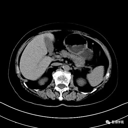 影像PPT - 【病例】胰腺实性假乳头状瘤1例CT影像-1 影像PPT - 【病例】胰腺实性假乳头状瘤1例CT影像-1