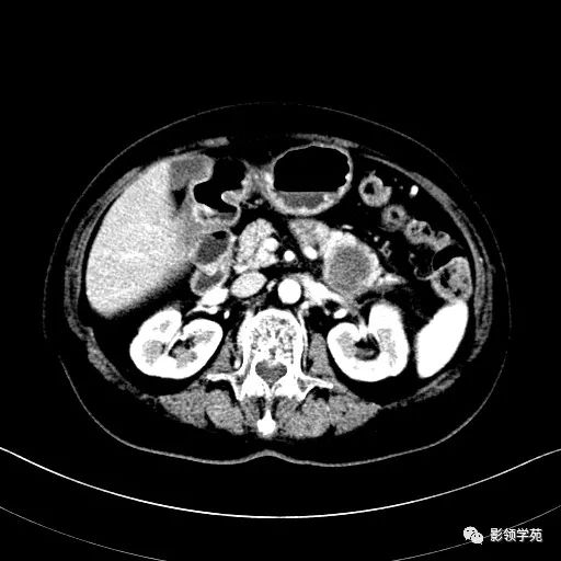 影像PPT - 【病例】胰腺实性假乳头状瘤1例CT影像-14 影像PPT - 【病例】胰腺实性假乳头状瘤1例CT影像-14