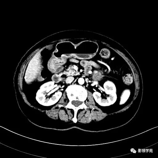 影像PPT - 【病例】胰腺实性假乳头状瘤1例CT影像-16 影像PPT - 【病例】胰腺实性假乳头状瘤1例CT影像-16