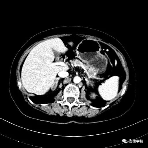 影像PPT - 【病例】胰腺实性假乳头状瘤1例CT影像-18 影像PPT - 【病例】胰腺实性假乳头状瘤1例CT影像-18