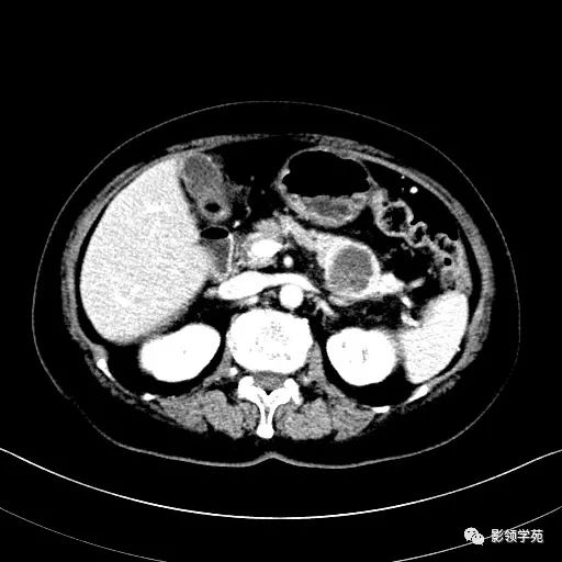 影像PPT - 【病例】胰腺实性假乳头状瘤1例CT影像-21 影像PPT - 【病例】胰腺实性假乳头状瘤1例CT影像-21