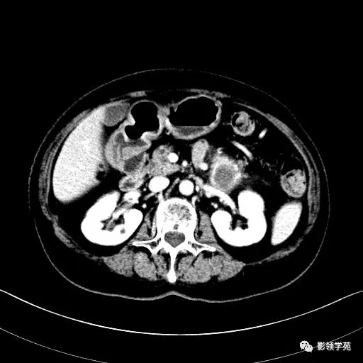 影像PPT - 【病例】胰腺实性假乳头状瘤1例CT影像-24 影像PPT - 【病例】胰腺实性假乳头状瘤1例CT影像-24