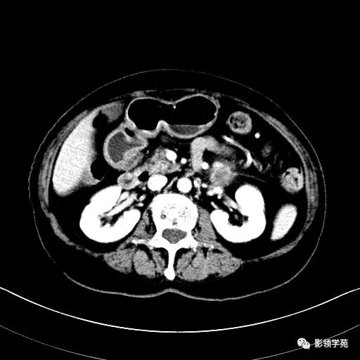 影像PPT - 【病例】胰腺实性假乳头状瘤1例CT影像-25 影像PPT - 【病例】胰腺实性假乳头状瘤1例CT影像-25