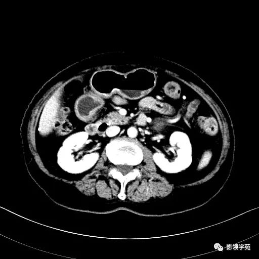 影像PPT - 【病例】胰腺实性假乳头状瘤1例CT影像-26 影像PPT - 【病例】胰腺实性假乳头状瘤1例CT影像-26