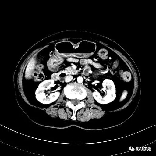 影像PPT - 【病例】胰腺实性假乳头状瘤1例CT影像-17 影像PPT - 【病例】胰腺实性假乳头状瘤1例CT影像-17