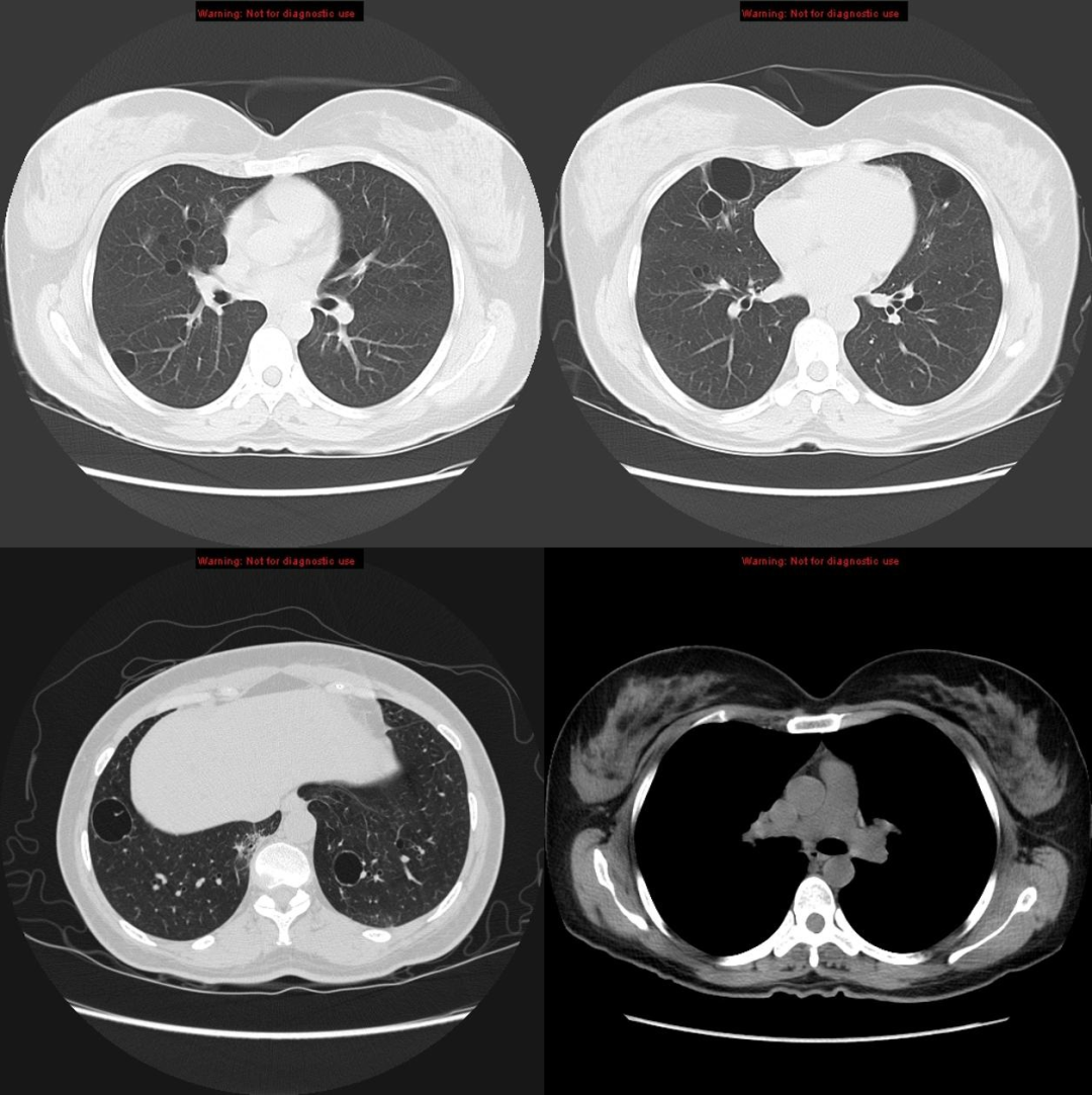 影像PPT - 肺淋巴管肌瘤病影像与临床-12