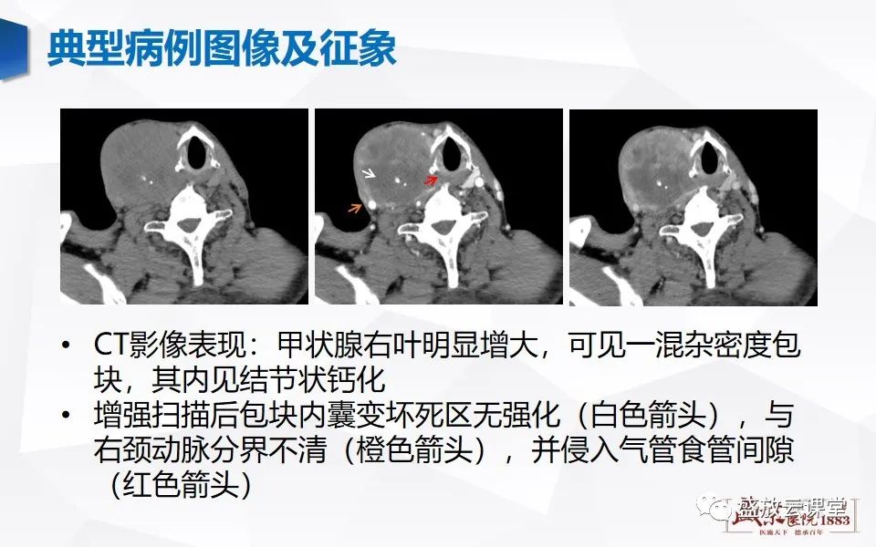 影像PPT - 【病例】甲状腺癌1例CT影像鉴别-4