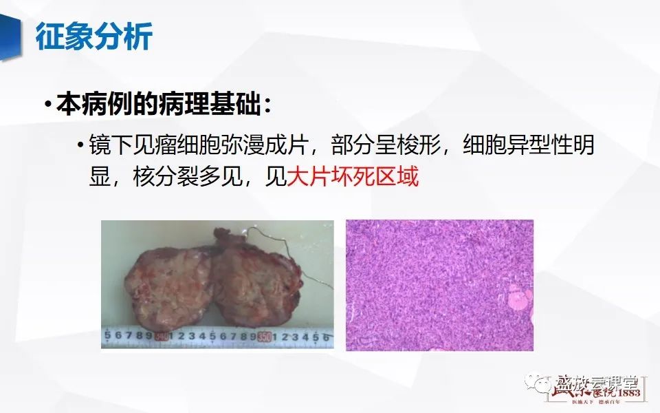 影像PPT - 【病例】甲状腺癌1例CT影像鉴别-6