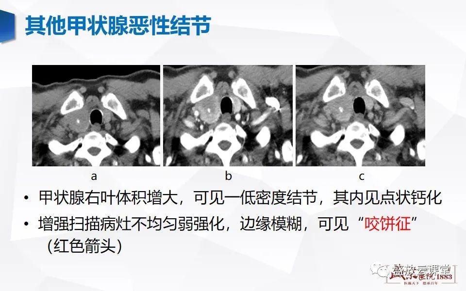 影像PPT - 【病例】甲状腺癌1例CT影像鉴别-13
