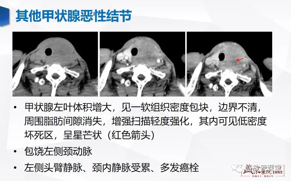 影像PPT - 【病例】甲状腺癌1例CT影像鉴别-15