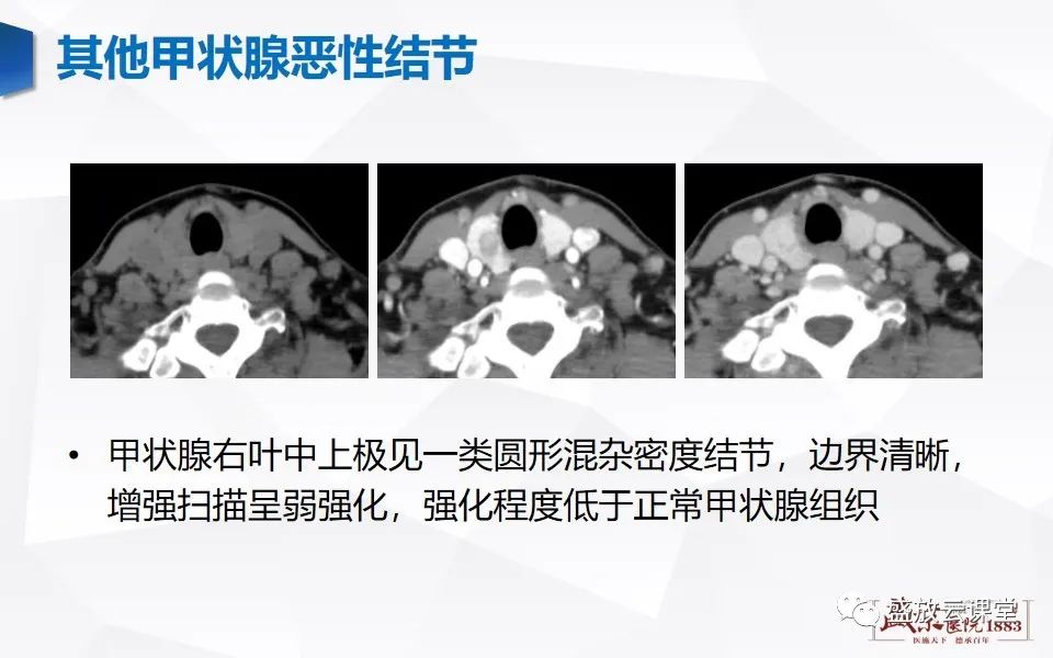影像PPT - 【病例】甲状腺癌1例CT影像鉴别-18