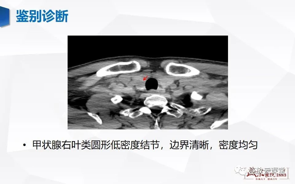 影像PPT - 【病例】甲状腺癌1例CT影像鉴别-24