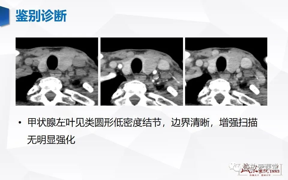 影像PPT - 【病例】甲状腺癌1例CT影像鉴别-21