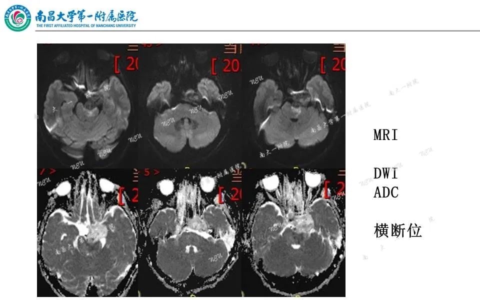 影像PPT - 【PPT】颅底肿瘤的影像诊断思路-4