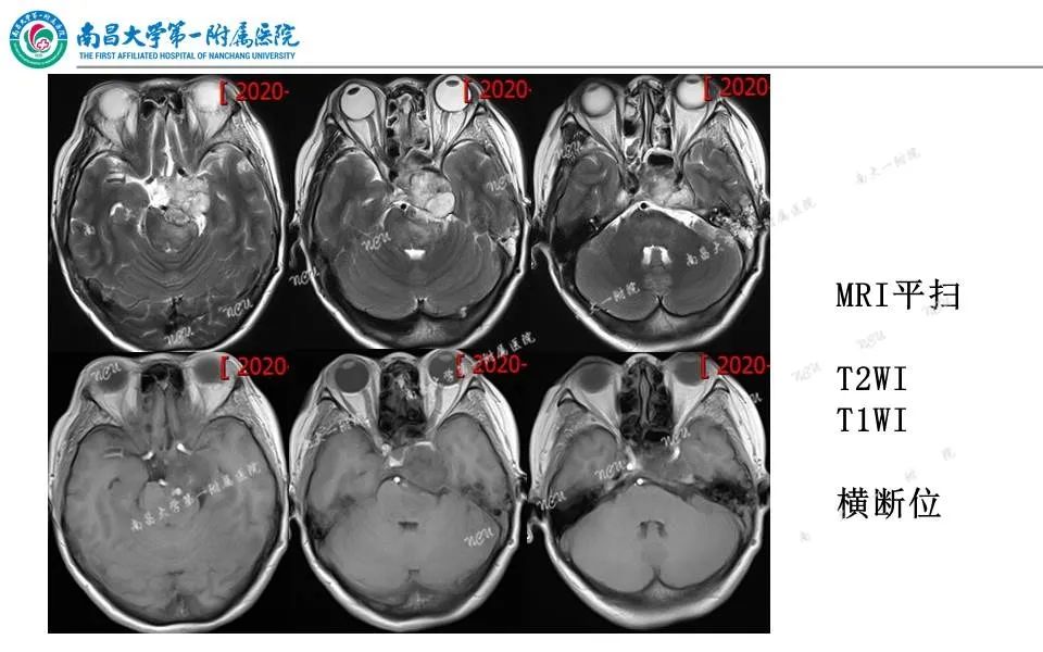 影像PPT - 【PPT】颅底肿瘤的影像诊断思路-3