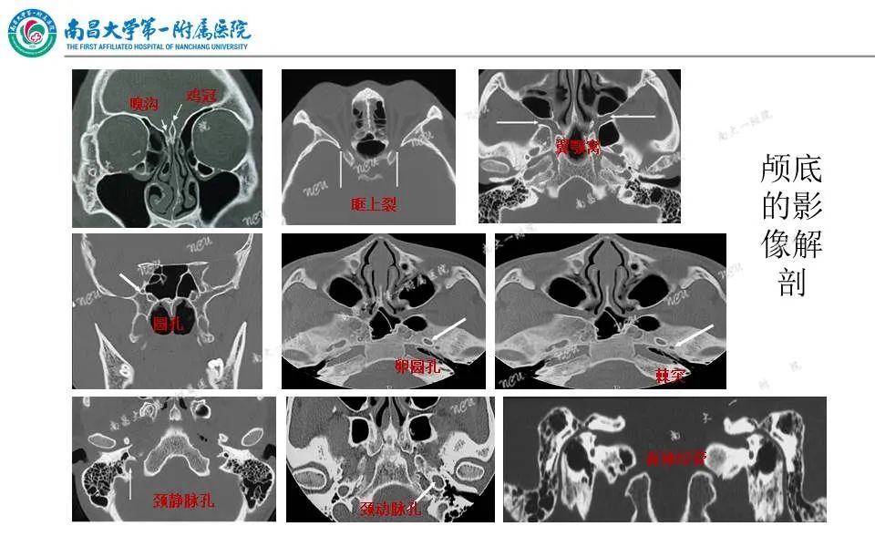 影像PPT - 【PPT】颅底肿瘤的影像诊断思路-15