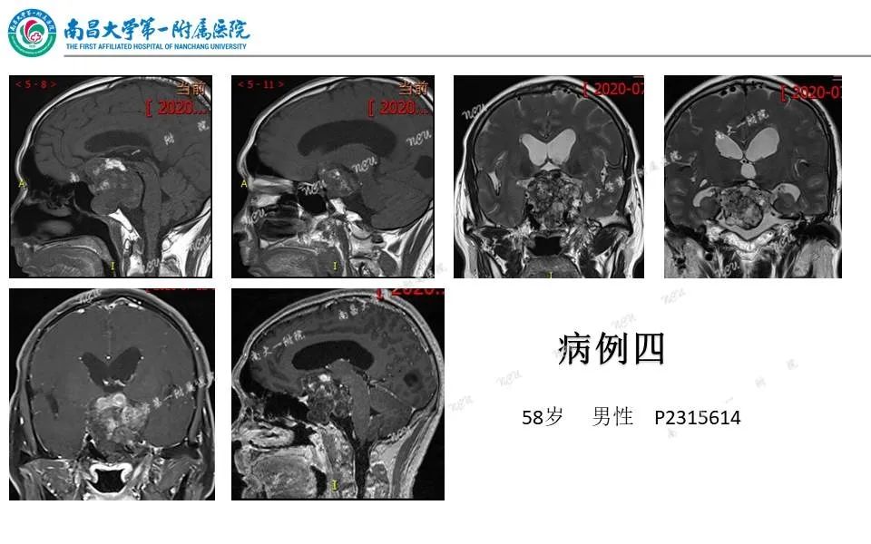影像PPT - 【PPT】颅底肿瘤的影像诊断思路-29