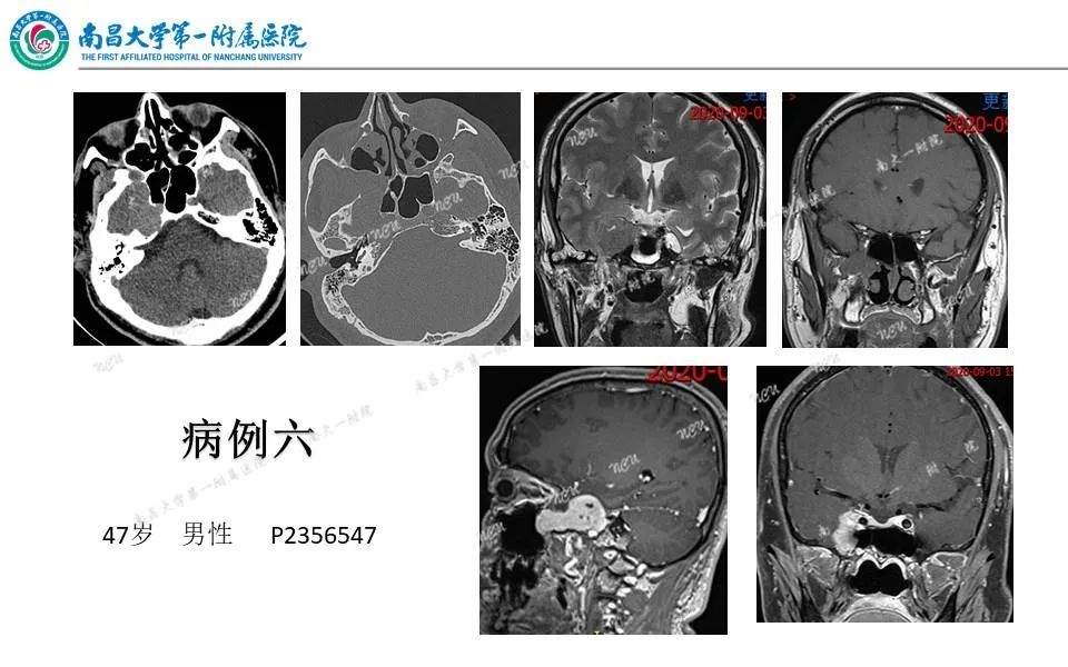 影像PPT - 【PPT】颅底肿瘤的影像诊断思路-33