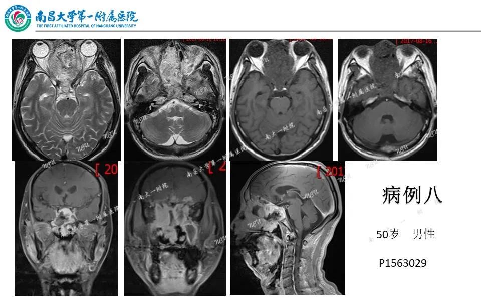 影像PPT - 【PPT】颅底肿瘤的影像诊断思路-37