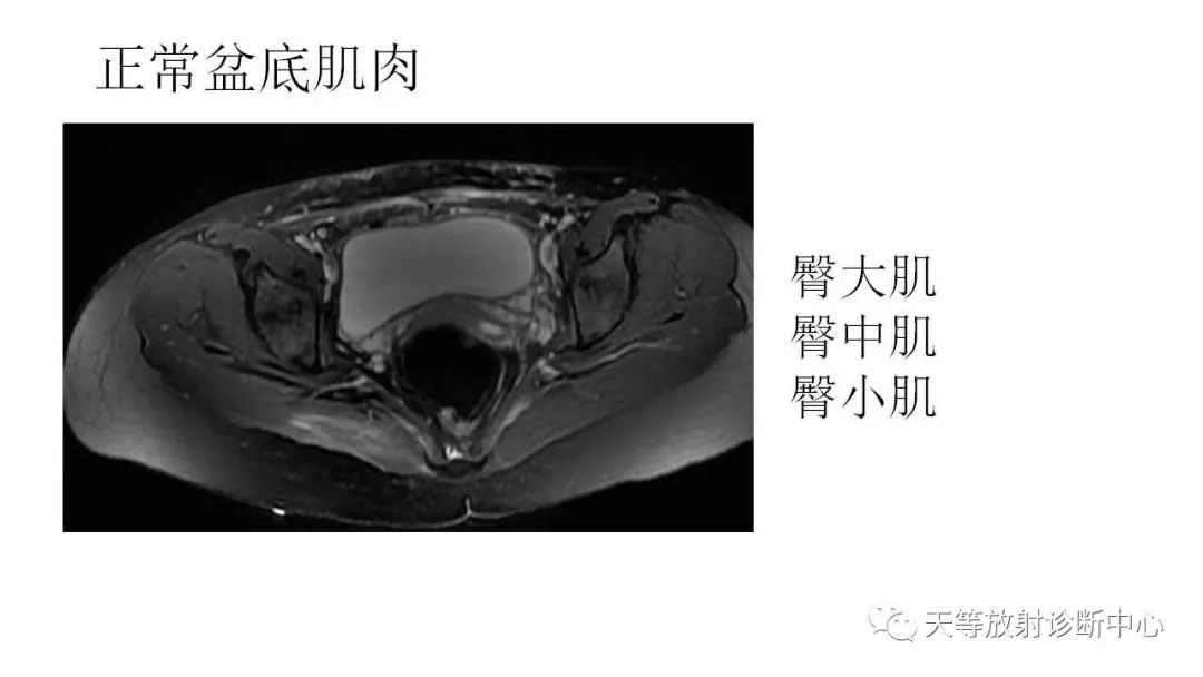 影像PPT - 【PPT】坐骨-股骨撞击综合征-3