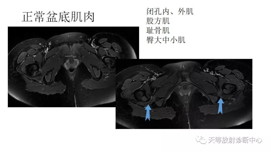 影像PPT - 【PPT】坐骨-股骨撞击综合征-2
