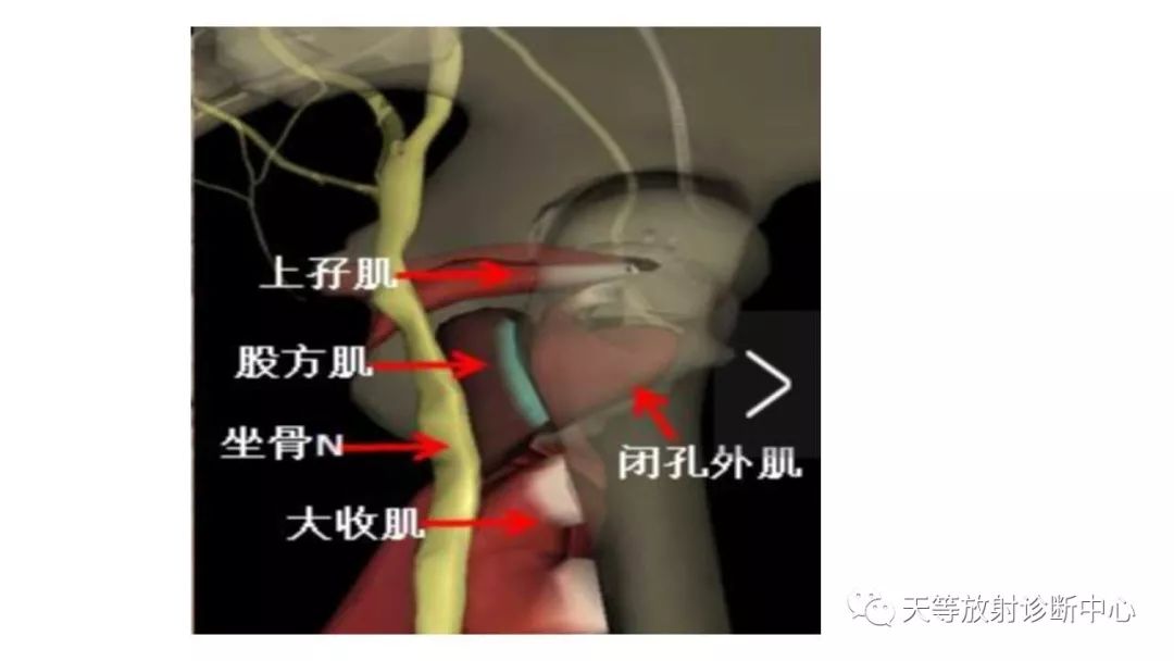 影像PPT - 【PPT】坐骨-股骨撞击综合征-8