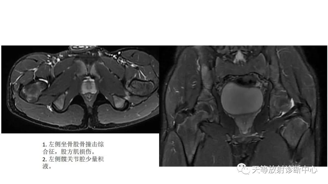 影像PPT - 【PPT】坐骨-股骨撞击综合征-10