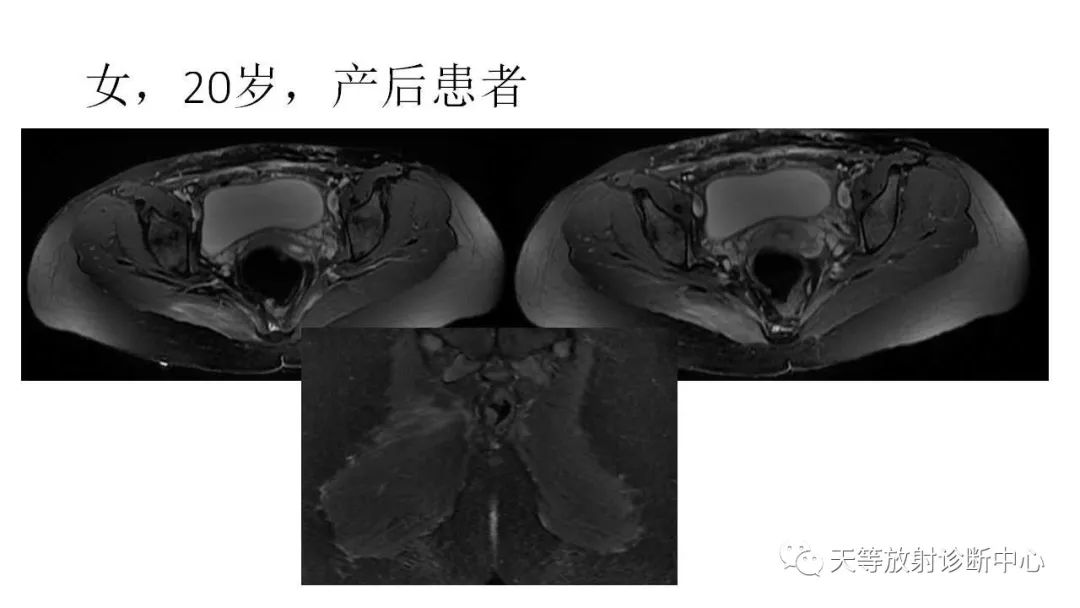 影像PPT - 【PPT】坐骨-股骨撞击综合征-15