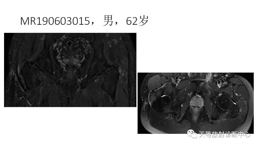 影像PPT - 【PPT】坐骨-股骨撞击综合征-18