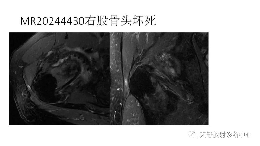 影像PPT - 【PPT】坐骨-股骨撞击综合征-20