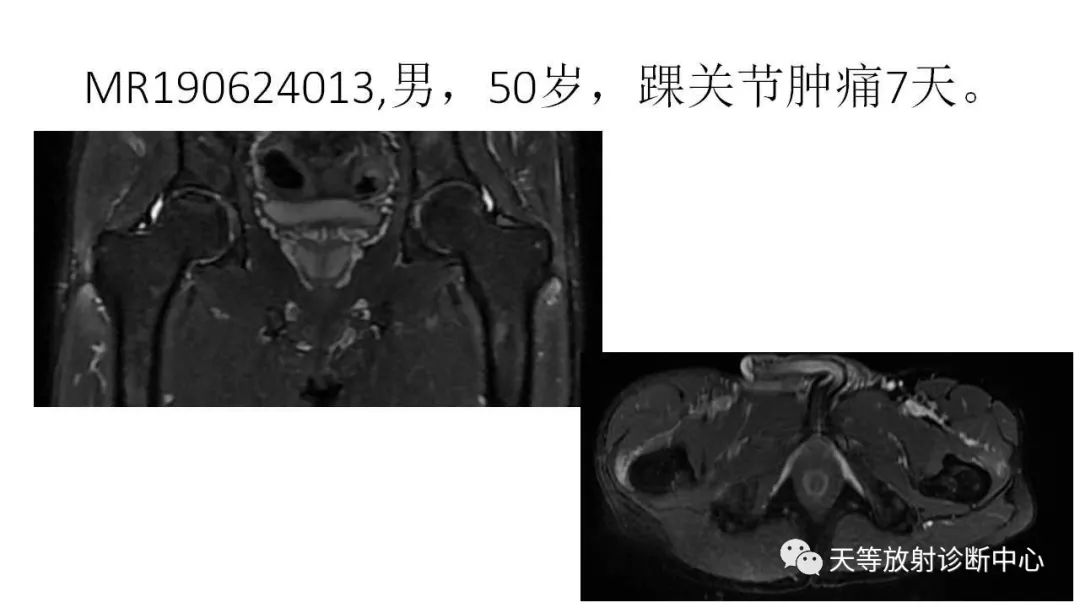 影像PPT - 【PPT】坐骨-股骨撞击综合征-21