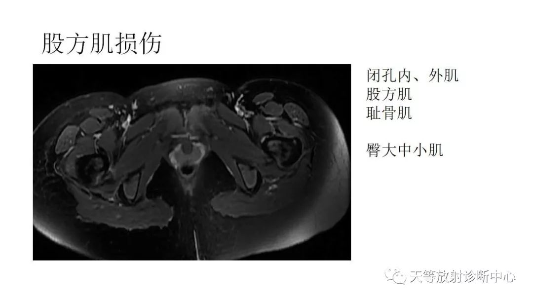 影像PPT - 【PPT】坐骨-股骨撞击综合征-22