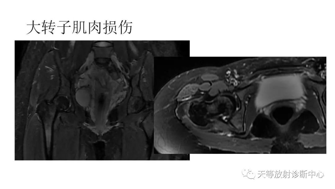 影像PPT - 【PPT】坐骨-股骨撞击综合征-24