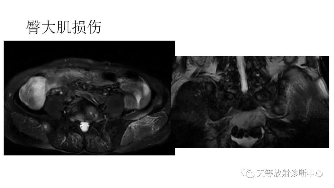 影像PPT - 【PPT】坐骨-股骨撞击综合征-25