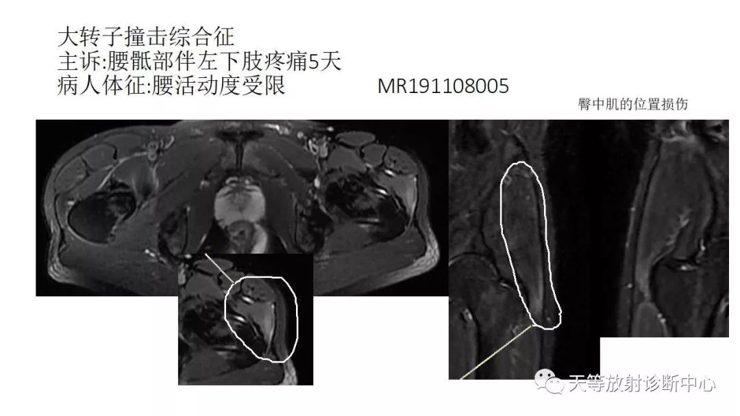 影像PPT - 【PPT】坐骨-股骨撞击综合征-27