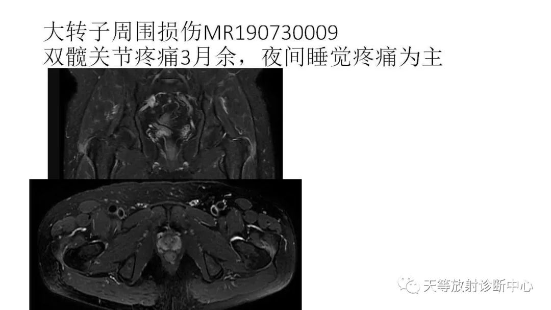 影像PPT - 【PPT】坐骨-股骨撞击综合征-26