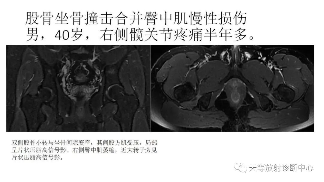 影像PPT - 【PPT】坐骨-股骨撞击综合征-28