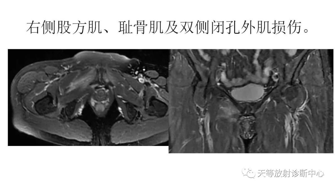 影像PPT - 【PPT】坐骨-股骨撞击综合征-23