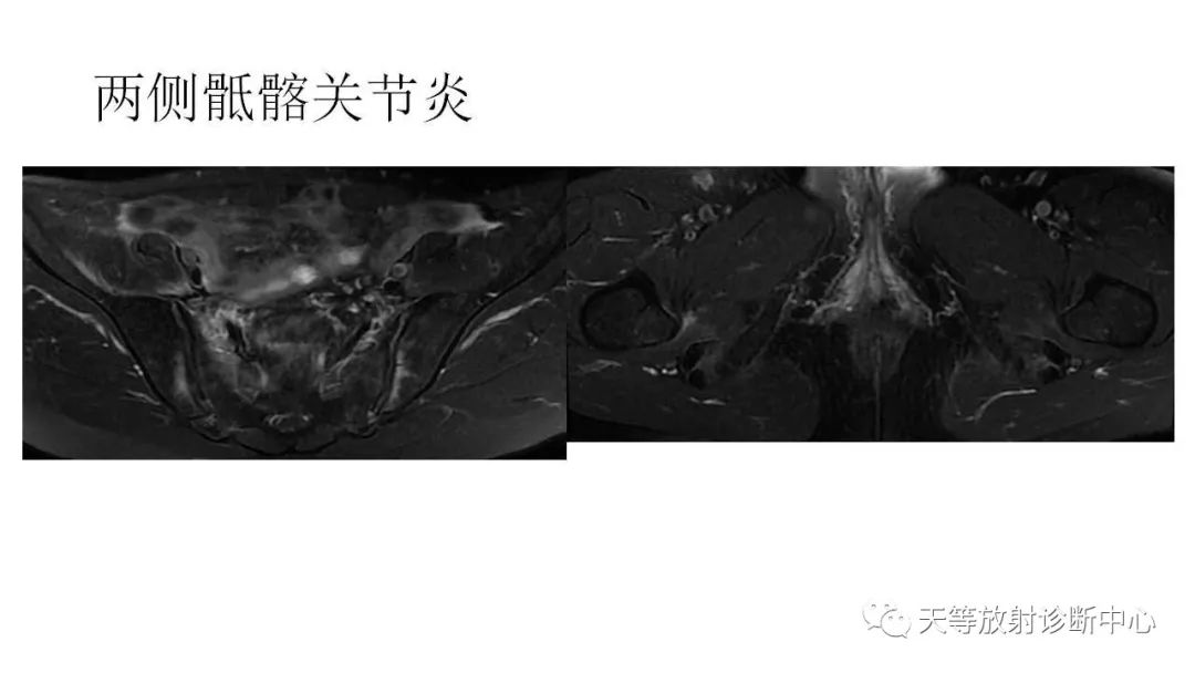 影像PPT - 【PPT】坐骨-股骨撞击综合征-33