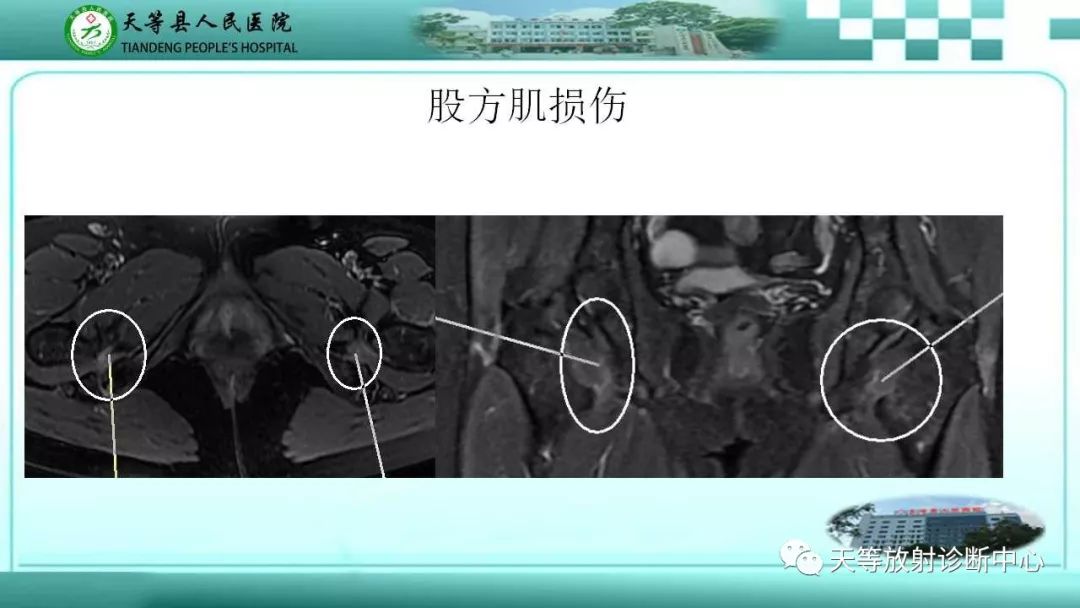 影像PPT - 【PPT】臀中肌损伤-8