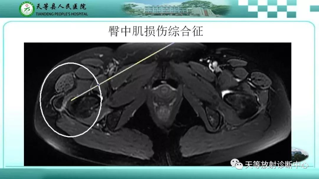 影像PPT - 【PPT】臀中肌损伤-7